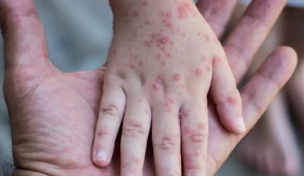 جذري القرود