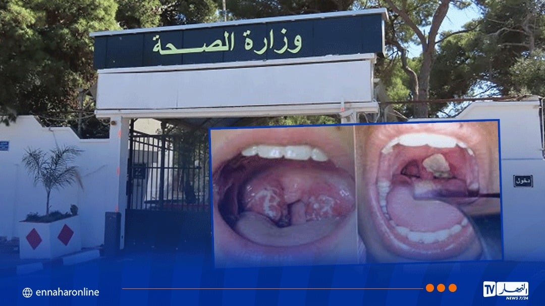 سكيكدة.. وفاة شخصين وتسجيل 5 حالات مؤكدة بداء الدفتيريا
